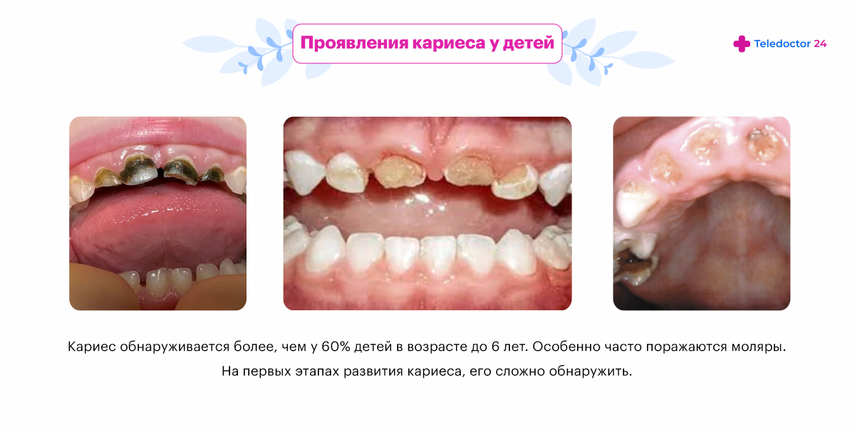 Виды болезней зубов у детей