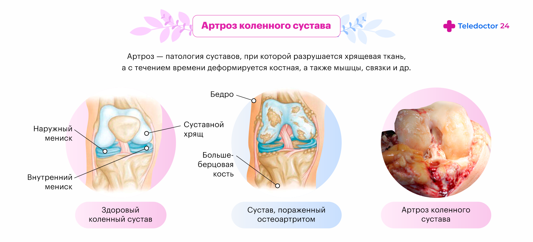 Как выглядит артроз коленного сустава