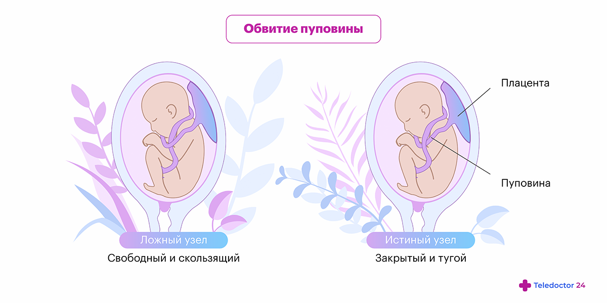 Пуповина плода гипоксия. Тройное обвитие пуповиной. Длина пуповины к концу беременности.
