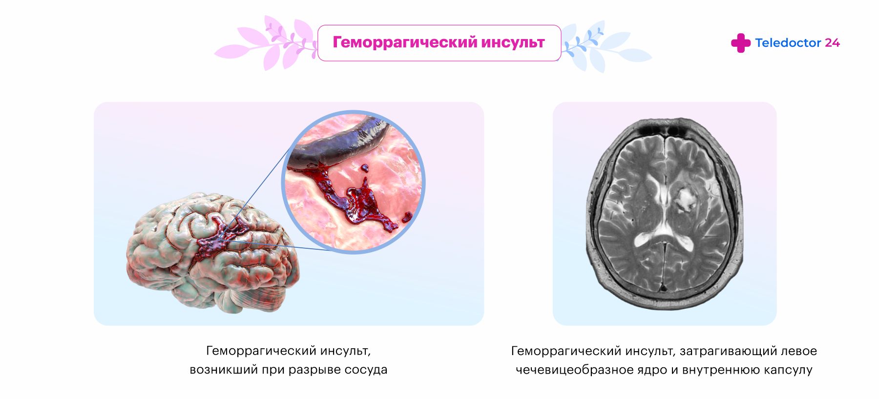 Геморрагический инсульт