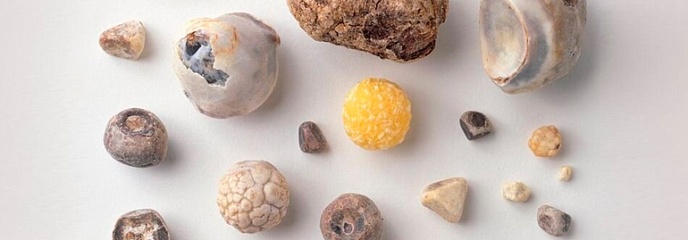 Камни в желчном пузыре