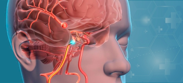 Аневризма головного мозга