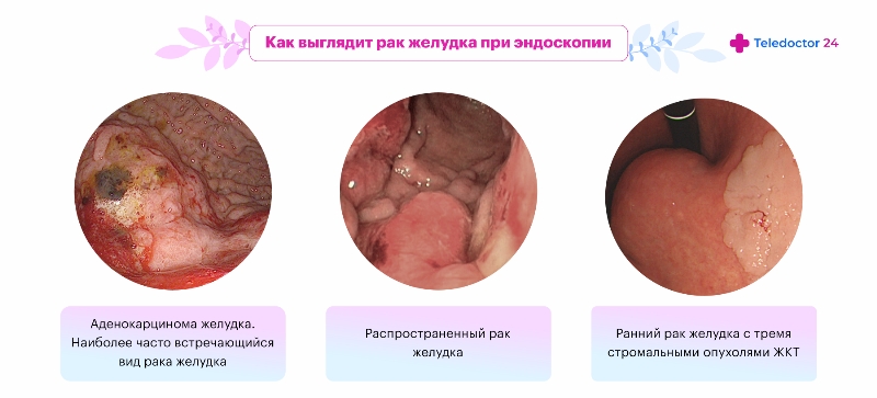 Как выглядит рак желудка при эндоскопии