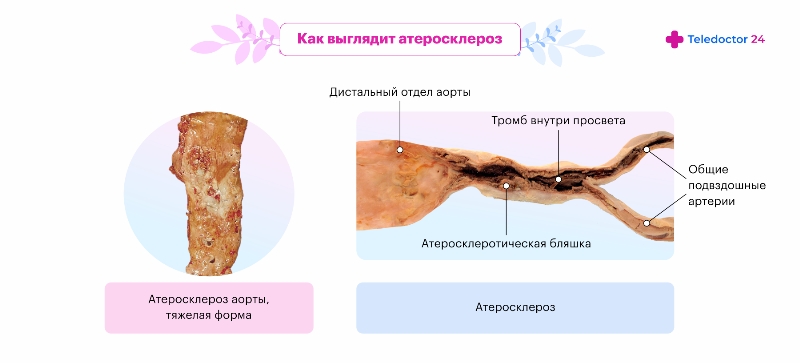 Как выглядит атеросклероз