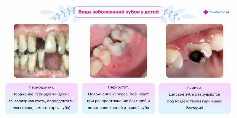 Проявления кариеса зубов
