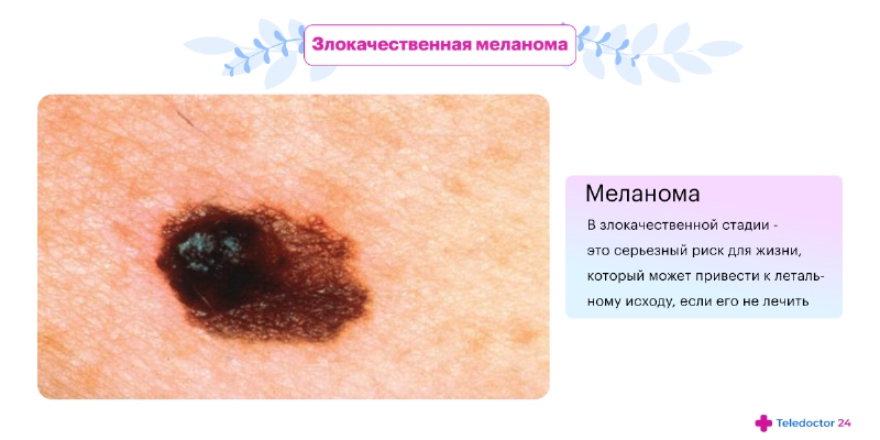  Как выглядит злокачественная меланома