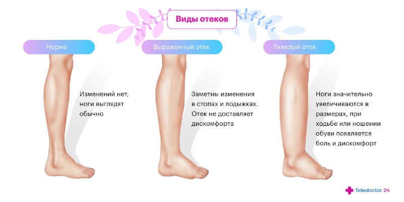 Отеки ног, причины и лечение отечности ног