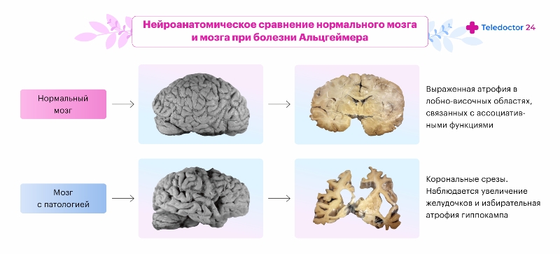 Нейроанатомическое сравнение нормального мозга и мозга при болезни Альцгеймера