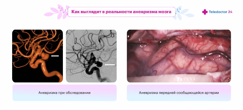 Как выглядит аневризма мозга