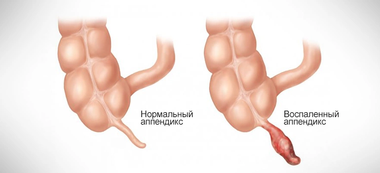 Фото: Классификация аппендицита