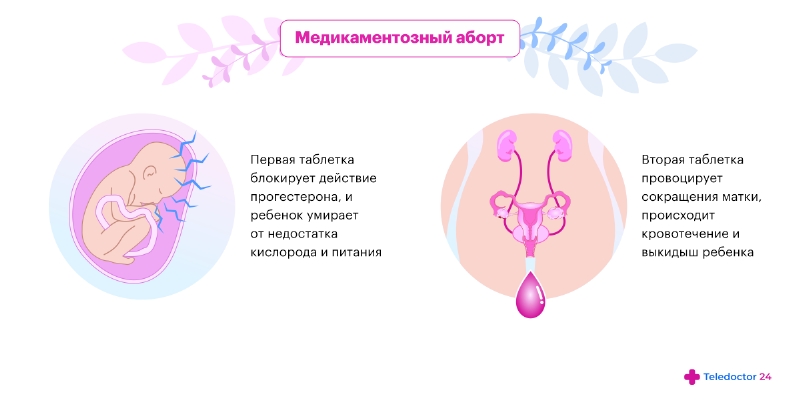 Замершая беременность - причины, симптомы, диагностика, лечение и профилактика