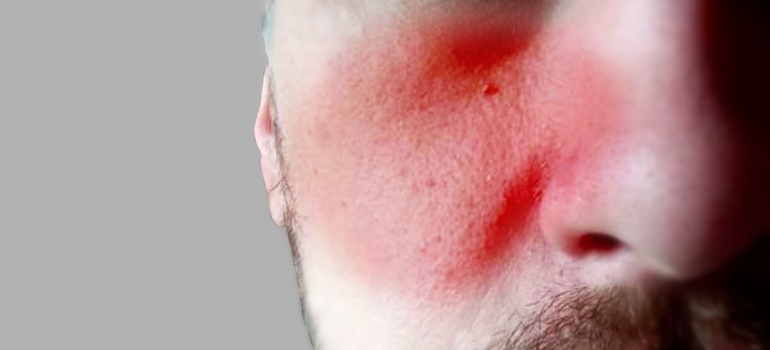 Лечение дерматита на лице