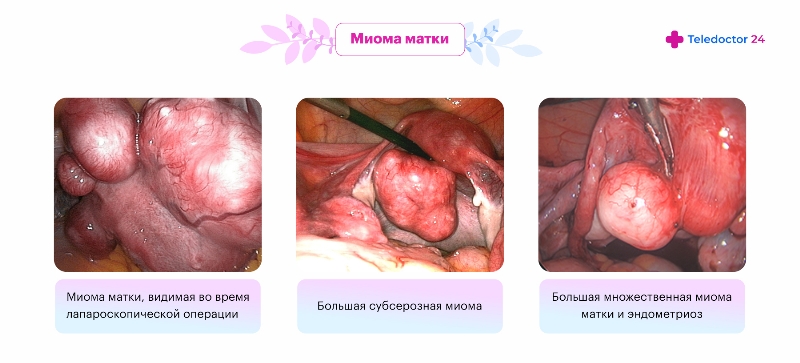 Миома матки