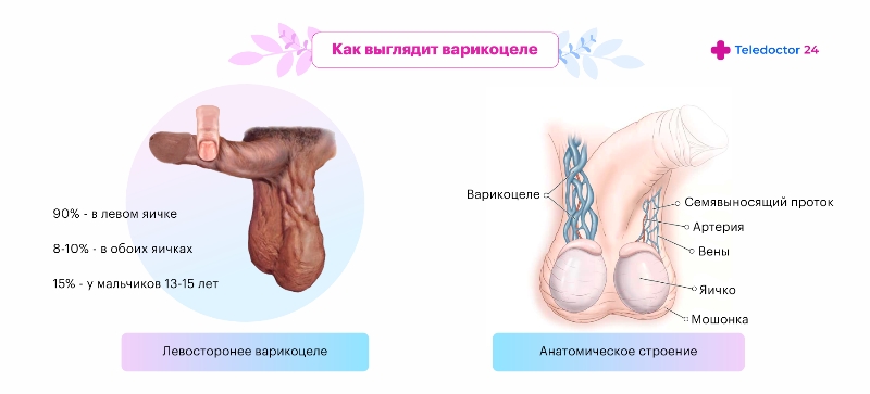 Как выглядит варикоцеле