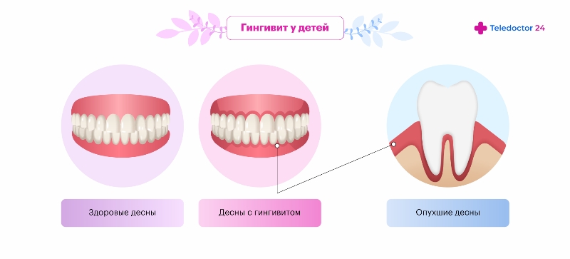 Гингивит у детей — причины, симптомы, методы диагностики и лечения гингивита у ребенка