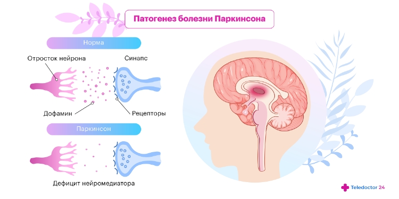 Лечение болезни Паркинсона — Центр экстрапирамидных и когнитивных расстройств