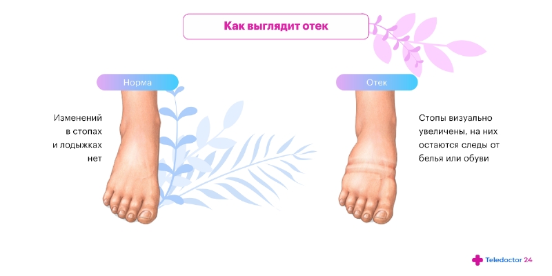 Отек ног после родов – причины появления, способы выявления и методы лечения