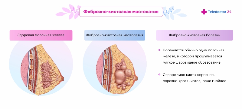 Что такое муковисцидоз?