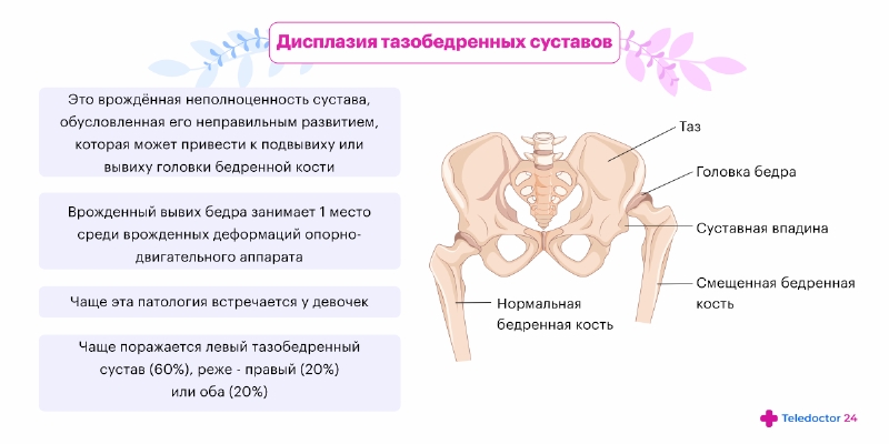 Дисплазия тазобедренного сустава и врожденный вывих бедра