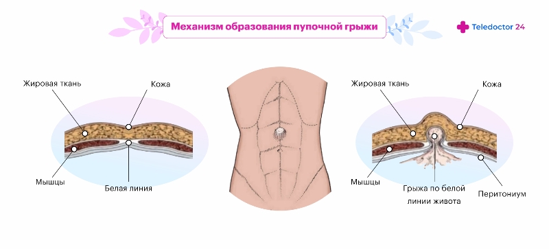 Пупочная грыжа у взрослых — как выглядит, симптомы, лечение