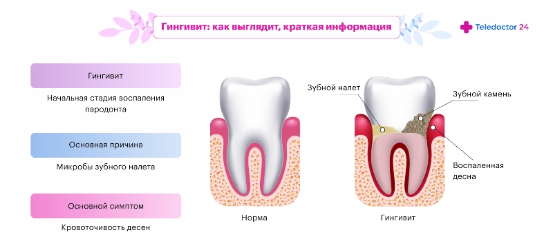 Болезни десен: лечение, фото | Пародонтит и пародонтоз | Пародонтология