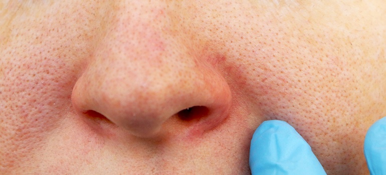 Как лечить лопнувшие капилляры на лице?